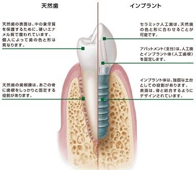 インプラント画像1