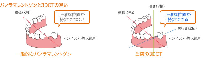 パノラマレントゲンと3DCTの違い画像