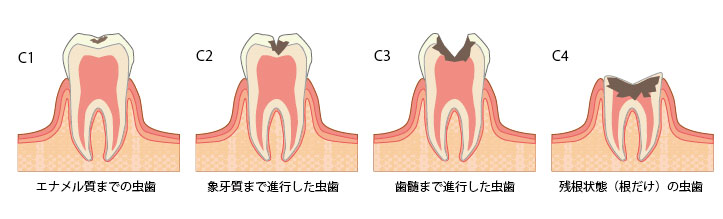 虫歯画像